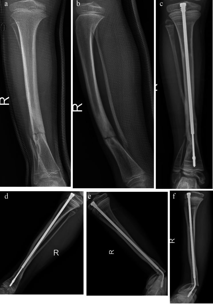 Radiographs showing distal migration of an intramedullary rod and later refracture with a bent inner core