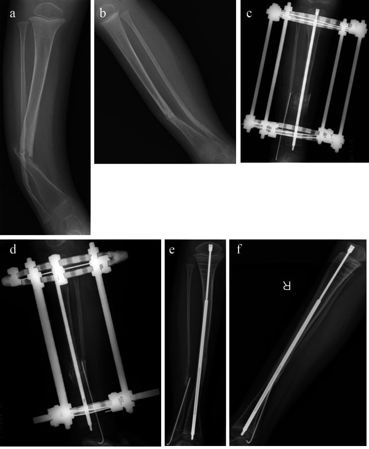 Preoperative, early postoperative and two-year radiographs after telescoping intramedullary rod fixation for congenital pseudarthrosis