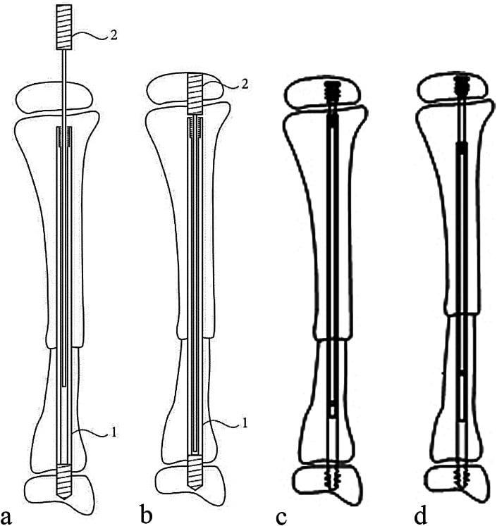 Schematic of an extensible telescoping intramedullary rod showing outer sleeve and inner core