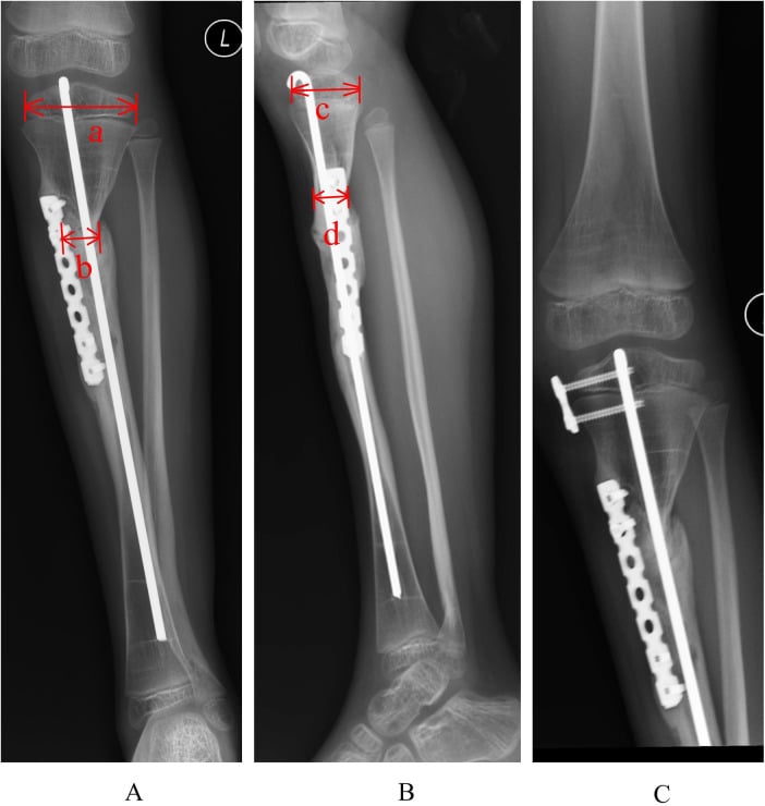 AP and lateral radiographs with the narrowest union diameters marked for cross-sectional area calculation