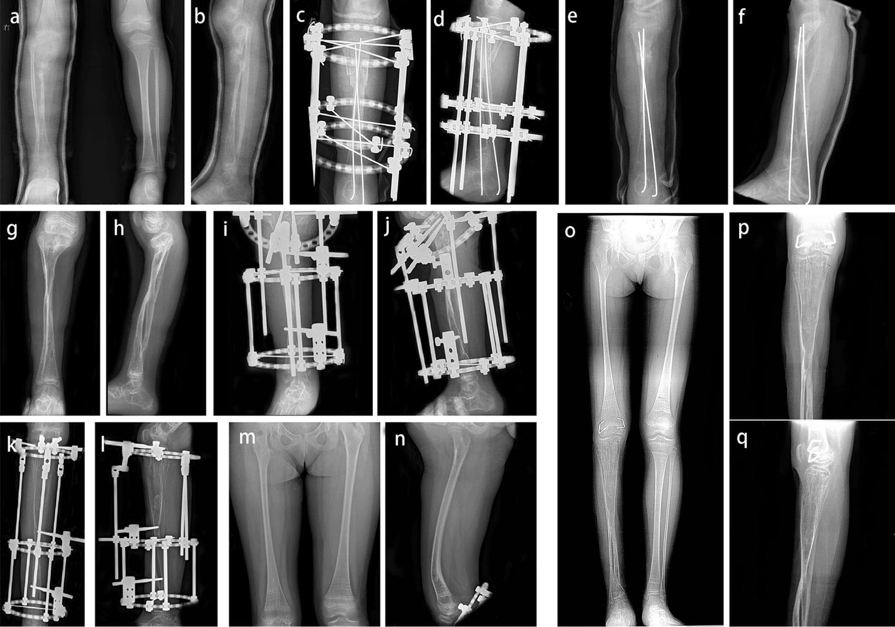 Serial radiographs of a large tibial defect treated by debridement, grafting, external fixation and ipsilateral fibular transfer