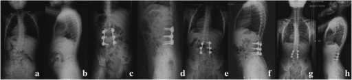 8-panel radiograph series showing congenital scoliosis surgical treatment