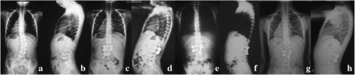 8-panel radiograph series showing congenital scoliosis treatment