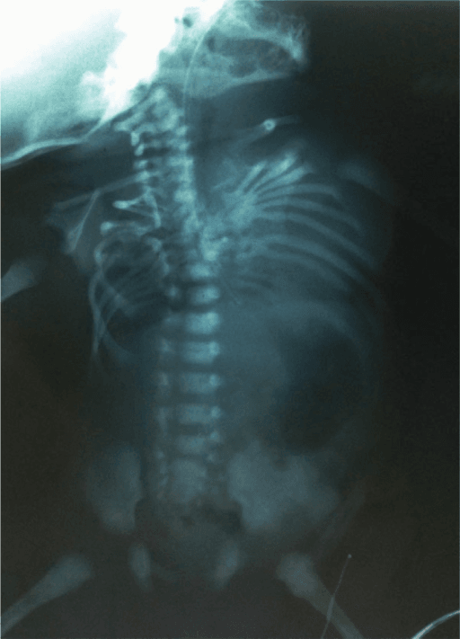 AP radiograph showing severe congenital thoracolumbar scoliosis in a child