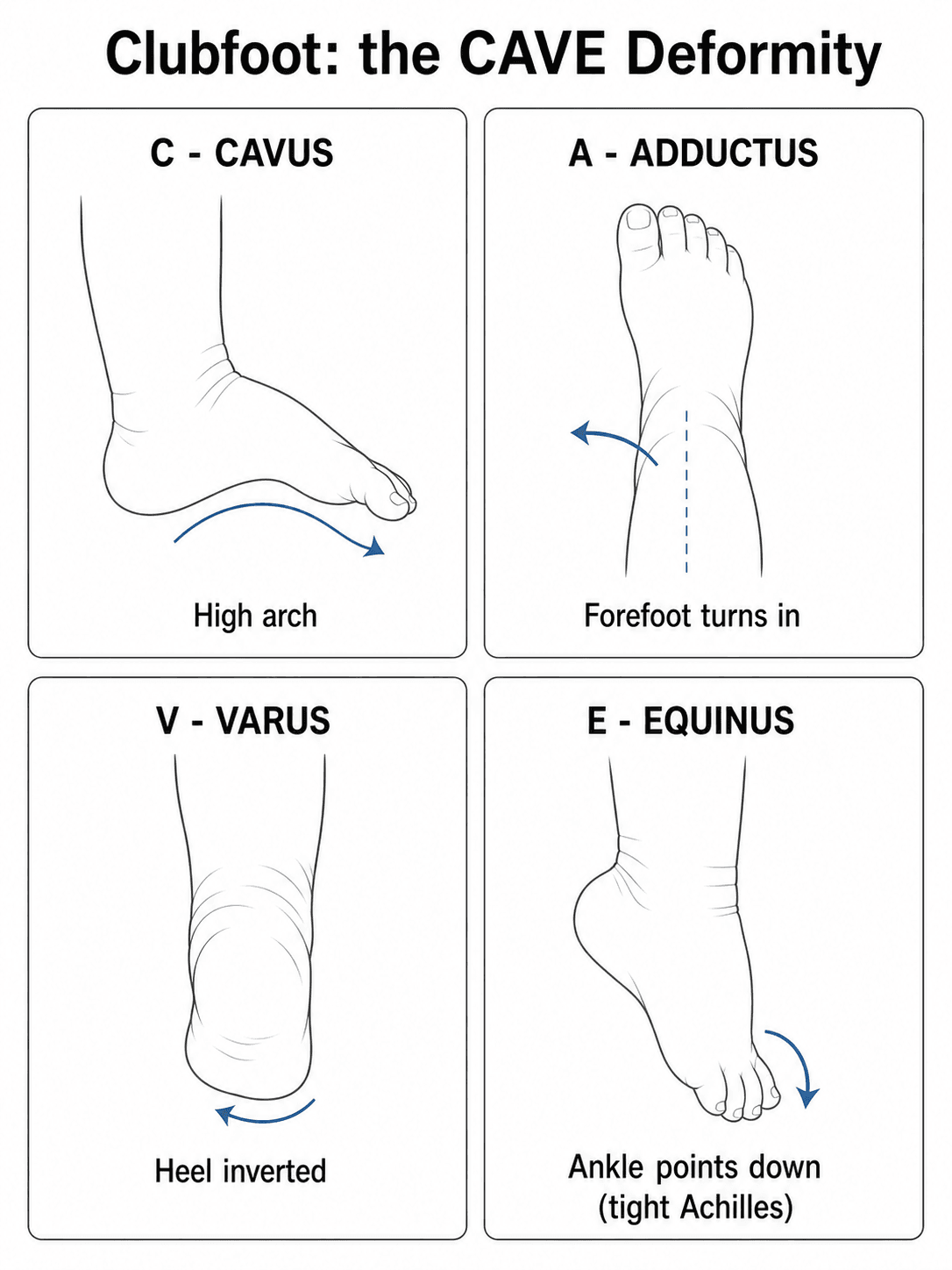 Four-panel schematic of the clubfoot CAVE deformity: cavus (high arch), adductus (forefoot turns in), varus (heel inverted) and equinus (ankle points down).