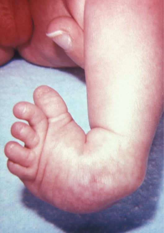 Clinical photograph of an infant clubfoot held in equinus, hindfoot varus and forefoot adduction.