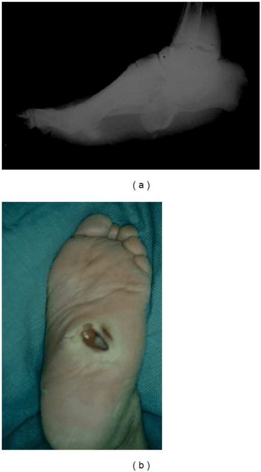 Congenital vertical talus: lateral radiograph of a rocker-bottom foot and a plantar photograph showing an ulcer over the prominent talar head.