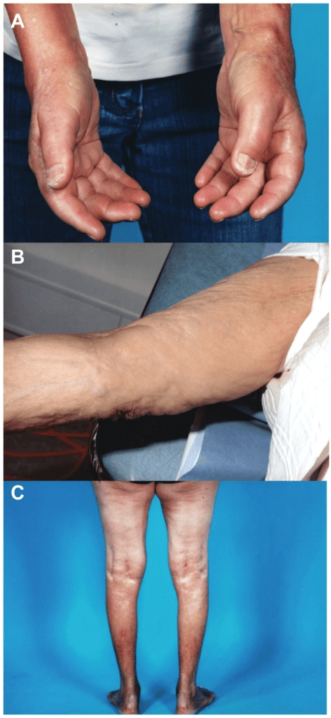 Clinical photographs of nephrogenic systemic fibrosis showing skin tightening and contractures