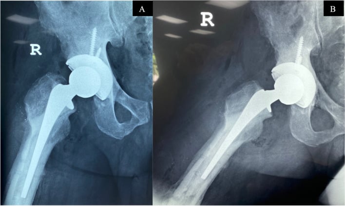 AP and lateral hip radiographs after implant removal and conversion THA, with the stem bypassing the empty lateral screw holes