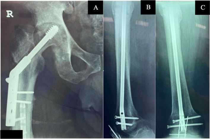 AP and lateral hip radiographs showing DHS lag-screw cut-out after an ipsilateral neck-and-shaft injury, with the shaft united