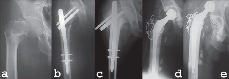 AP hip radiographs showing DHS lag-screw cut-out, then cemented conversion THA with trochanteric wiring
