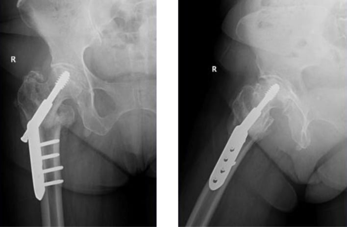 AP hip radiograph showing femoral-neck nonunion around a dynamic hip screw