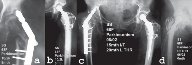 Sequential AP hip radiographs: subtrochanteric fracture, DHS pull-out at four months, then revision to a proximal femoral nail that later cut out