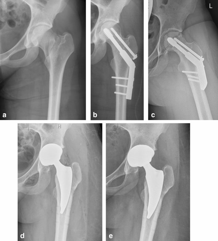 Five-panel sequence: displaced femoral-neck fracture, DHS fixation, later cut-out, then conversion THA on AP and lateral views