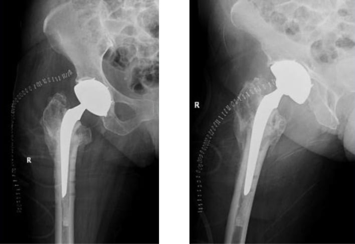 AP hip radiograph after conversion THA with a dual-mobility cup and a cement restrictor distal to the last screw hole