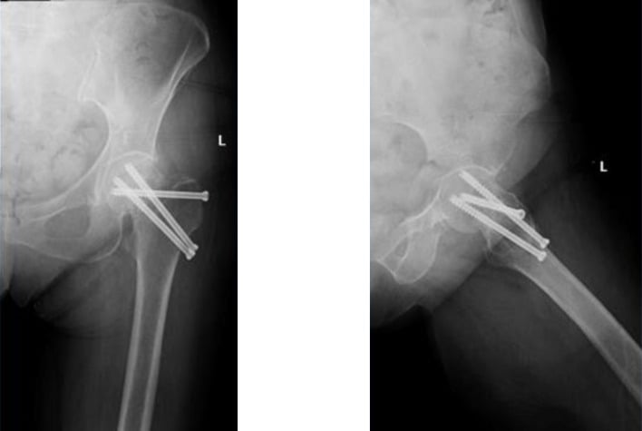 AP hip radiograph showing femoral-neck nonunion after cannulated-screw fixation