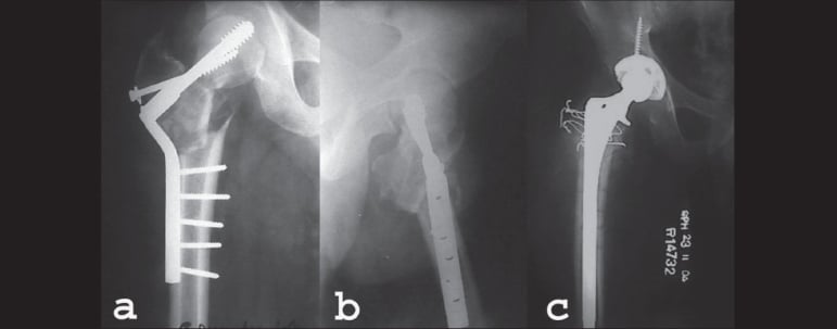 Sequential radiographs of an intertrochanteric fracture treated with a proximal femoral nail that collapsed and backed out, then converted to cemented THA