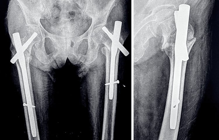 AP pelvis radiograph showing left PFNA-II helical-blade cut-out through the femoral head