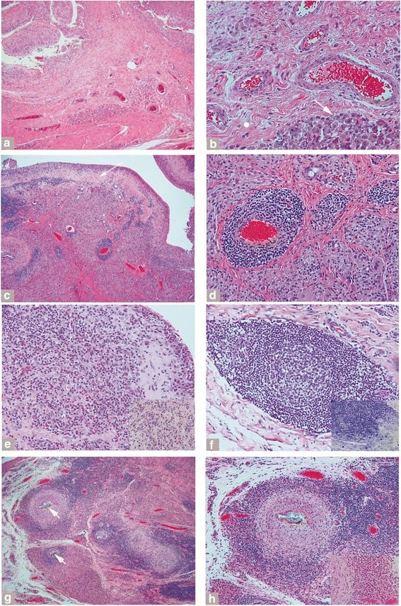 Histological patterns of adverse local tissue reaction around metal-on-metal hip implants