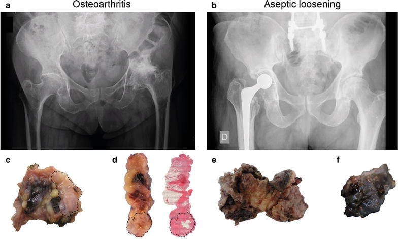 Radiographs and retrieved tissues showing aseptic loosening and metallosis around a hip implant