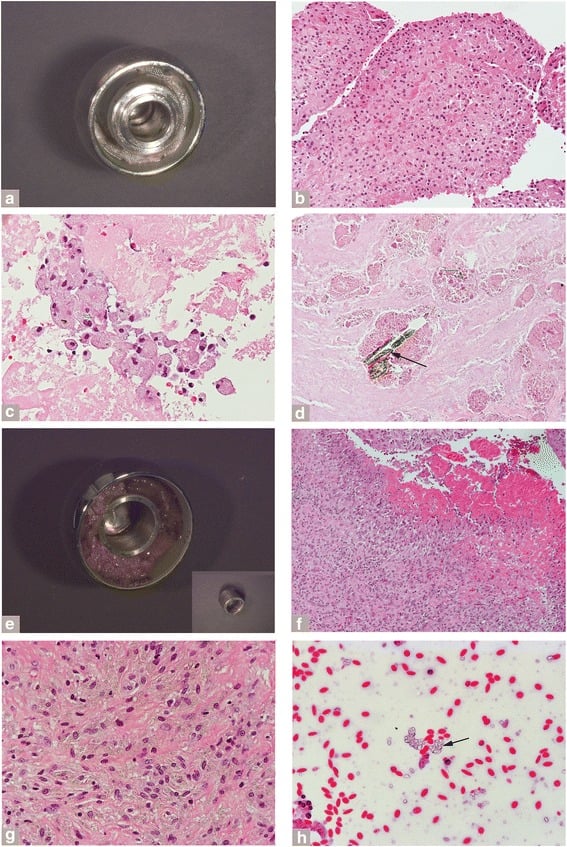 Metallic head, necrotic debris and macrophage-rich tissue in adverse local tissue reaction