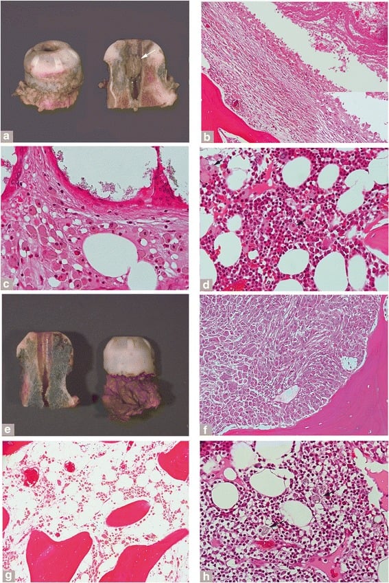 Osteolysis and histological change in a retrieved metal-on-metal resurfacing implant
