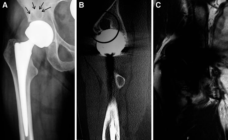 Radiograph, CT and MRI assessment of periprosthetic change around a metal-on-metal hip