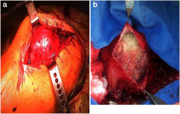 Intraoperative exposure of a well-circumscribed periprosthetic cyst