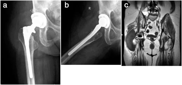 Radiographs and MRI demonstrating a large periprosthetic cyst after total hip arthroplasty