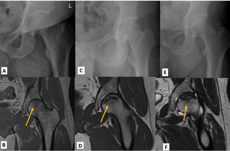 Anteroposterior hip radiographs showing progression of avascular necrosis through Ficat stages one to three
