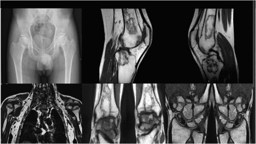 Radiographs and MRI of avascular necrosis in a young patient after high cumulative-dose corticosteroid therapy
