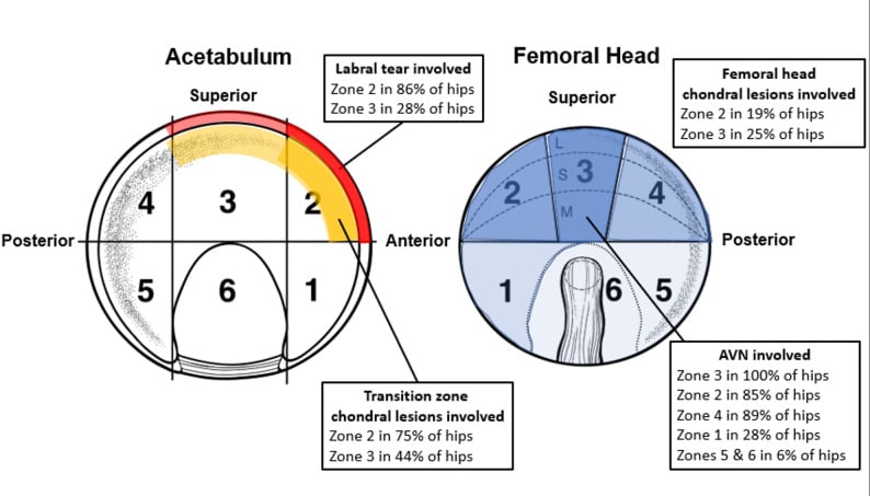Diagram of the geographic zone method for localising acetabular and femoral head pathology