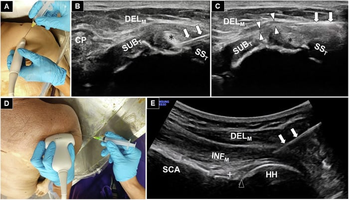 Probe position and needle placement for an ultrasound-guided rotator interval injection with corresponding ultrasound