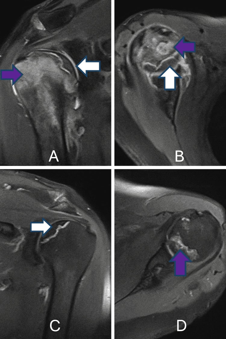 Coronal MRI of bilateral shoulder osteonecrosis showing a crescentic subchondral lesion