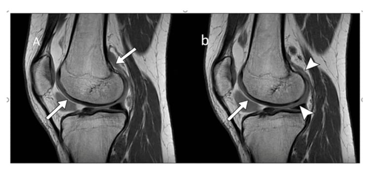 Sagittal MRI of the knee showing joint effusion and synovial thickening