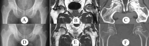 Six-panel imaging study of both hips with radiographs, MRI and CT of osteonecrosis of the femoral head