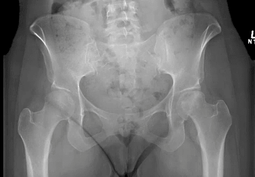 AP pelvis radiograph showing sclerosis and loss of the round contour of one femoral head