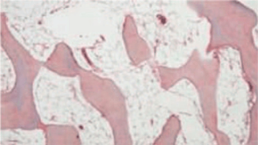 H and E histology of femoral head bone showing trabeculae with empty marrow spaces