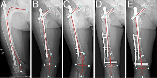 5-panel surgical treatment progression for coxa vara