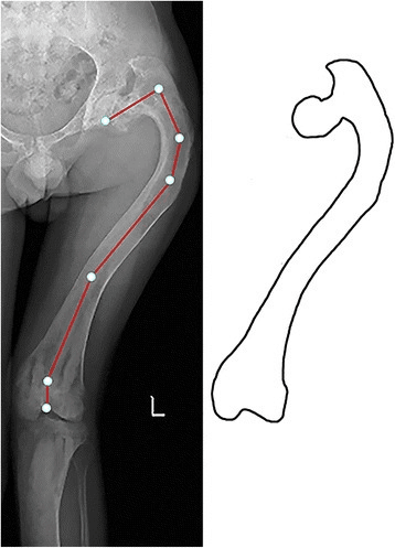 Coxa vara with shepherd's crook deformity - X-ray and diagram