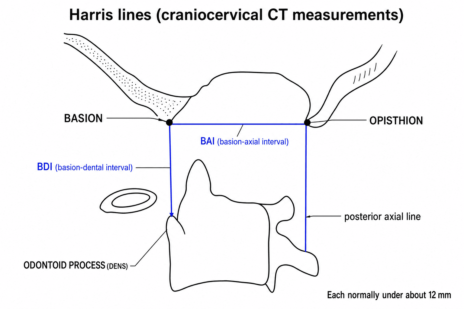Labelled line diagram of the craniocervical junction showing the basion, opisthion, odontoid, and the Harris basion-dental (BDI) and basion-axial (BAI) measurement lines