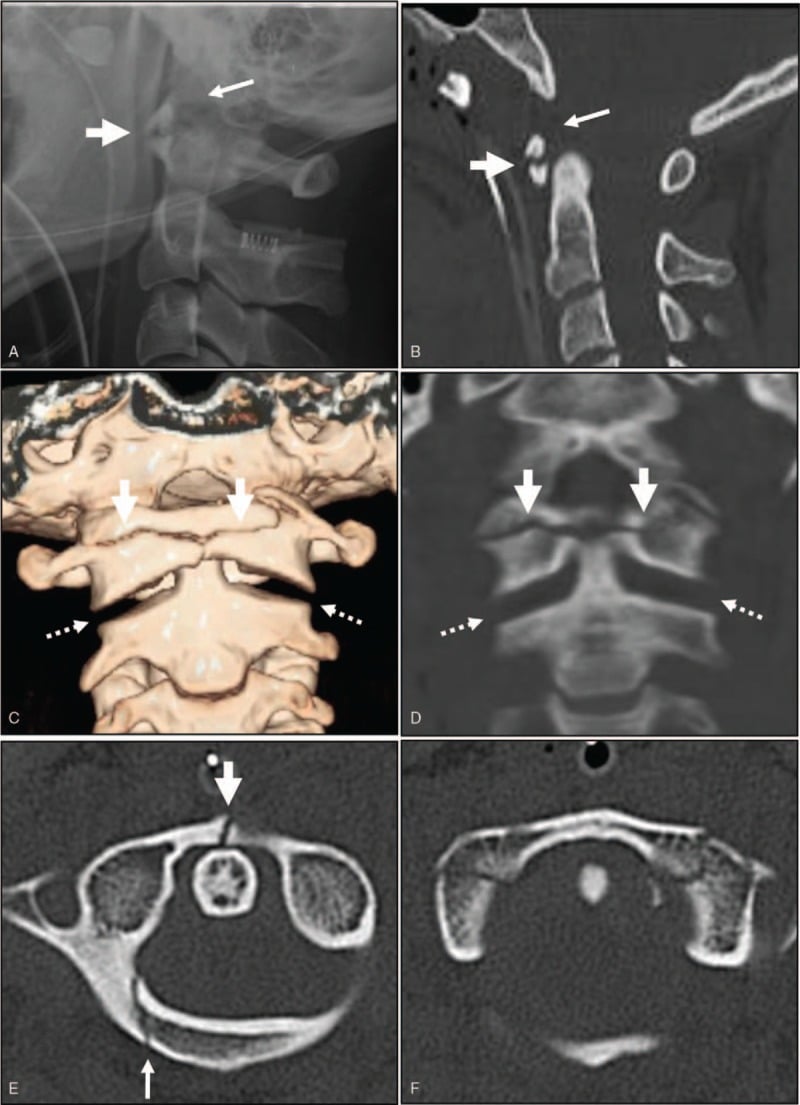 Lateral radiograph and sagittal CT of combined atlanto-occipital and atlanto-axial dislocation with a basion-dental interval of 18 mm