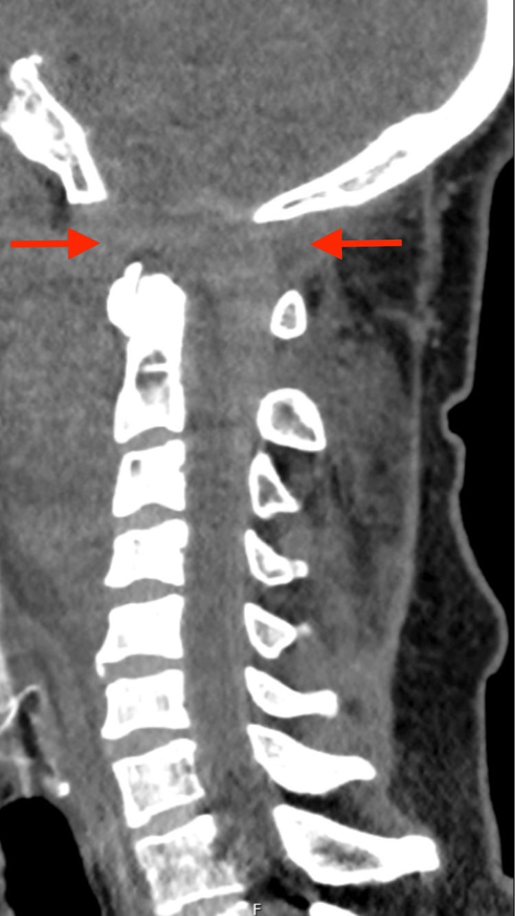 Sagittal CT reconstruction showing widening of the occiput-C1 joint space