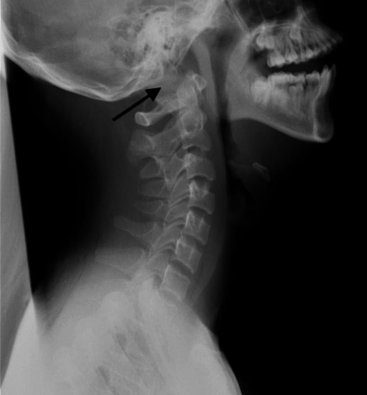 Lateral cervical radiograph showing atlanto-occipital subluxation
