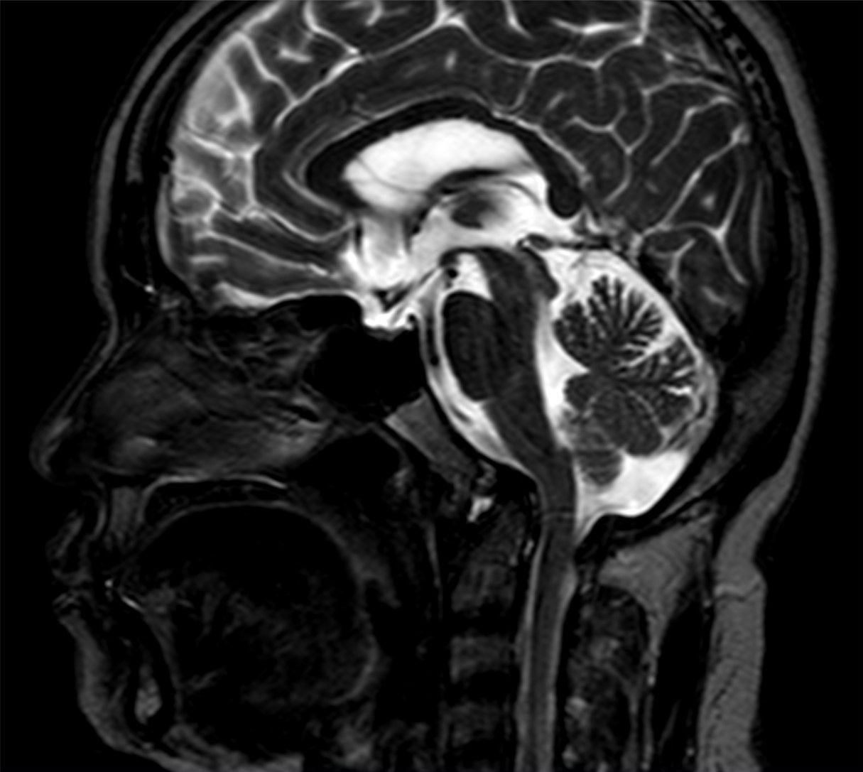 Midline sagittal T2 MRI of the craniocervical junction showing basilar invagination with the odontoid migrating toward the brainstem