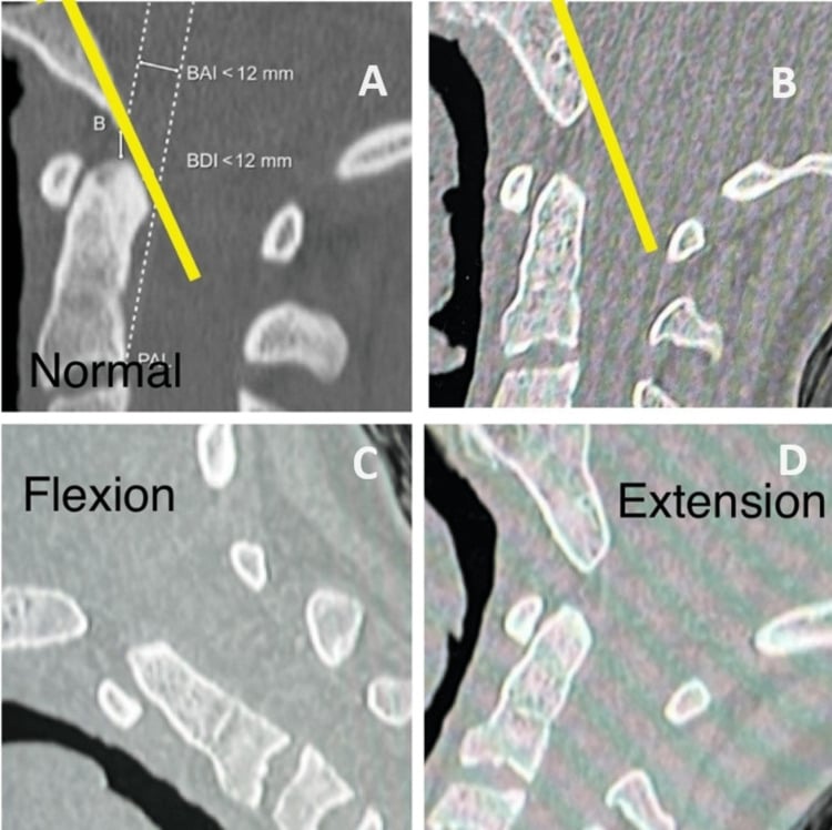 Sagittal CT in neutral, flexion and extension showing a widened basion-dens interval compared with a normal reference