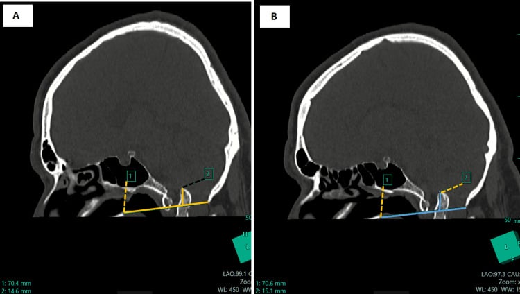 Sagittal CT with Chamberlain and McGregor lines showing the odontoid tip 14 mm above both