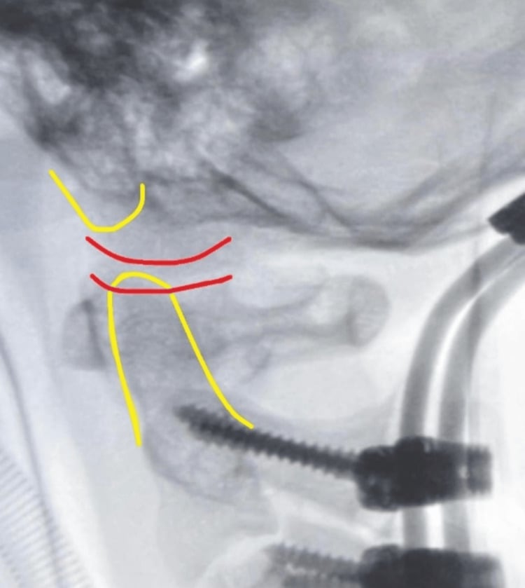 Postoperative lateral radiograph after occipitocervical fusion with restored cranio-cervical alignment