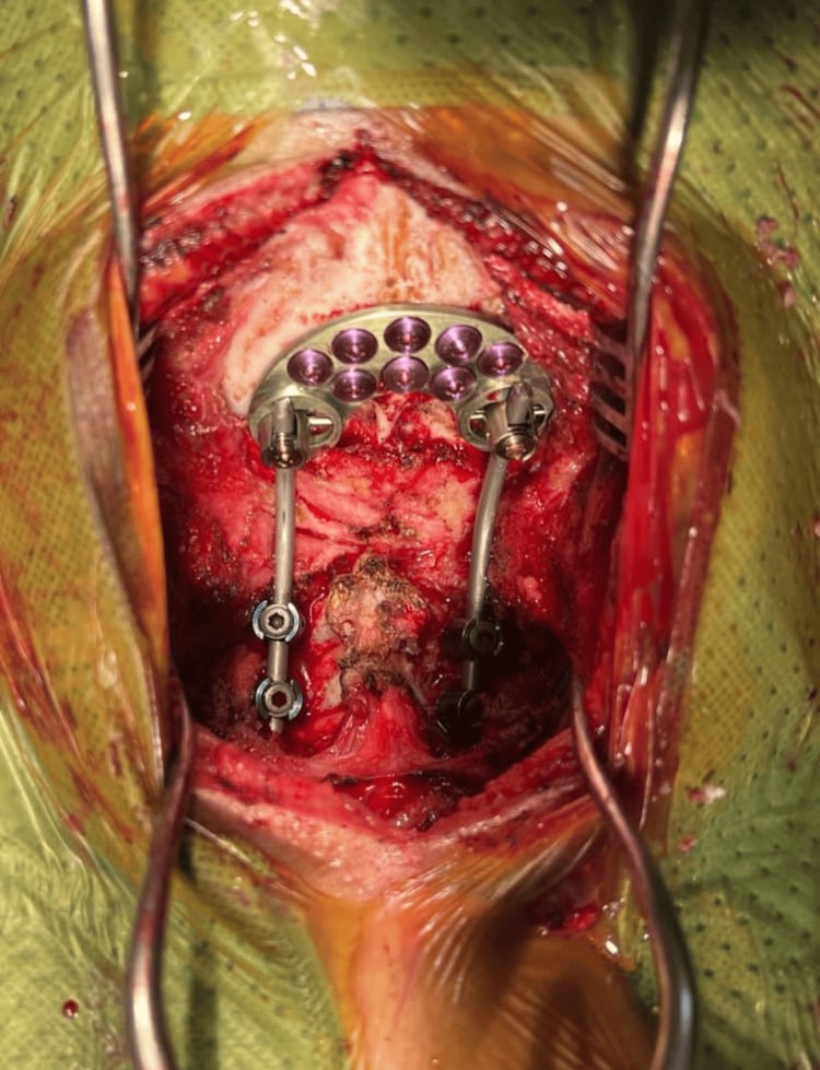 Intraoperative photograph of a posterior occiput-to-C2/C3 screw-rod construct