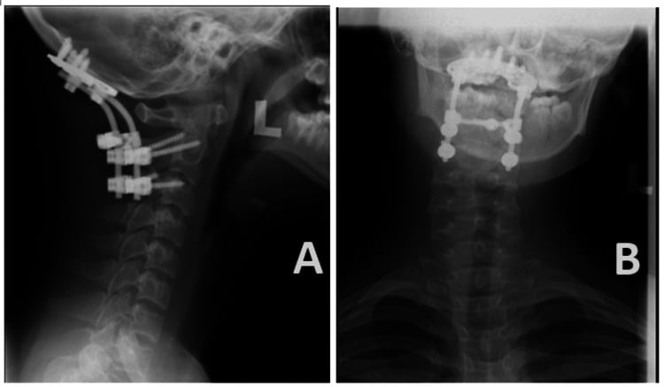 One-year lateral and anteroposterior radiographs of an intact occipitocervical construct